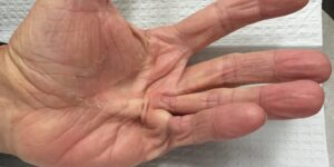 Read more about the article “WHEN FASCIA GOES ROGUE” PART I