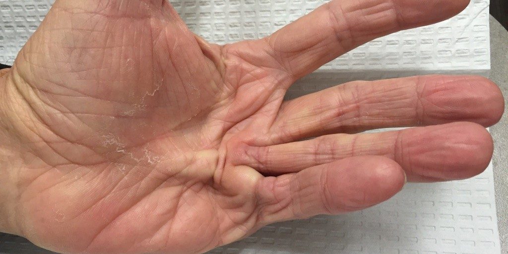 “WHEN FASCIA GOES ROGUE” PART I