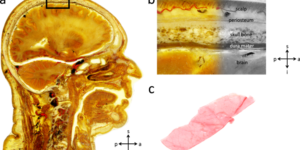 Read more about the article Meningeal Fascia
