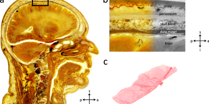 Meningeal Fascia