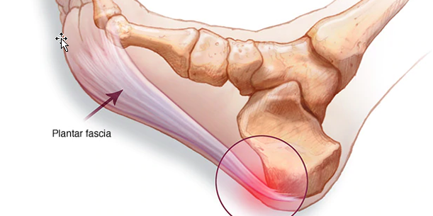 “WHEN FASCIA GOES ROGUE II”