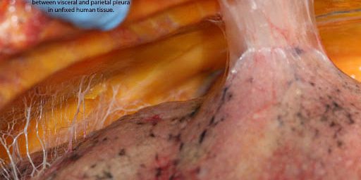 Densification and Fibrosis
