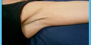Fascia and Scar Tissue, Part II
