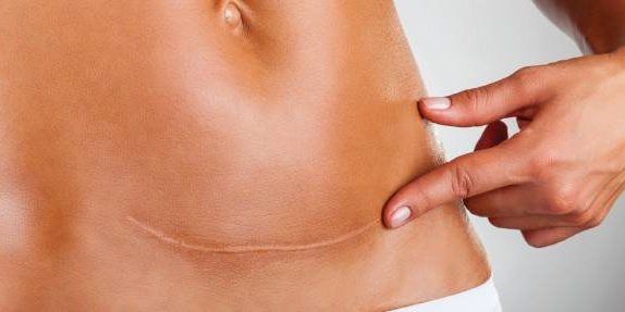 Fascia and Scar Tissue